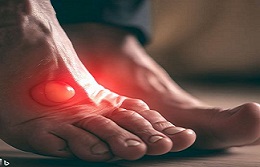 Unraveling Gout: An In-depth Look at Causes, Symptoms, and Treatment